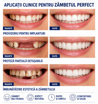 NovaSmile™ – Fațete Dentare Detașabile Tip Snap-On